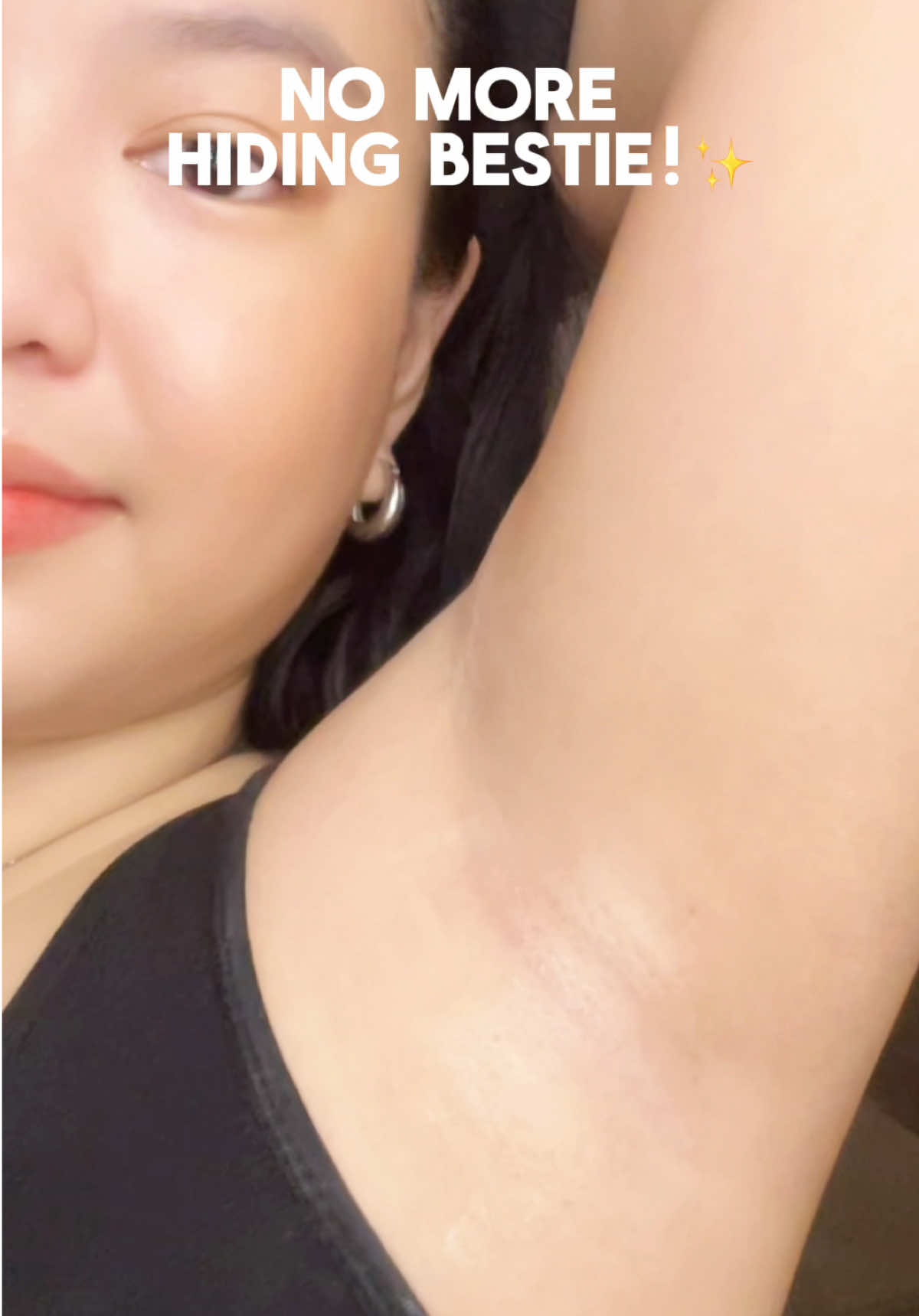 no more hiding besties!🤞🏻✨ @SKINEVER PH  #skinever#kilikili#discoloration#underarmwhitening#skineverdoubledaysale