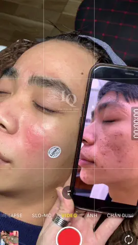Cập nhật da sẹo #chamsocdamun#chamsocdaseo#chamsocdanam#tanbinh#Lqspa 