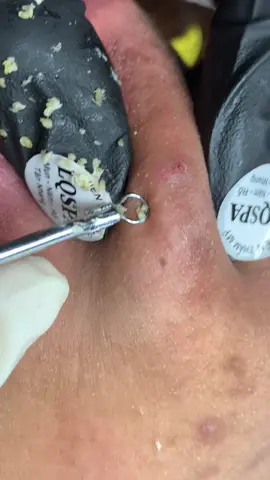 Nè #chamsocdamun#chamsocdaseo#chamsocdanam#tanbinh#Lqspa&academy 