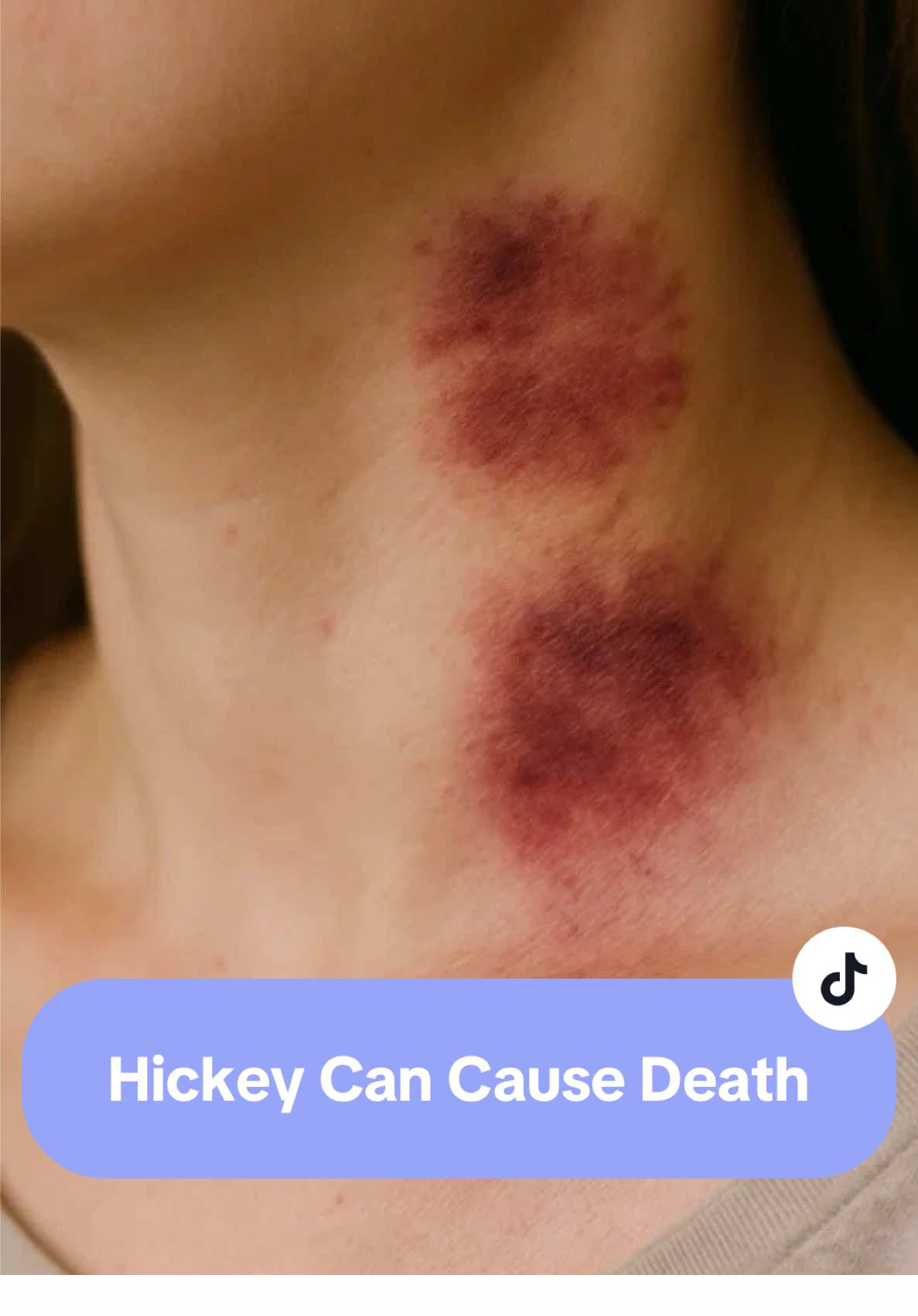 A hickey( love bite ) can lead to stroke and even death of a person. So be careful🙏🏽 . . . #draniket #hickey #stroke #healthtips #awarness 