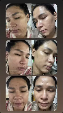 8 ngày sử dụng COMBO MỤN nhà Giao, như này cứ phải gọi là trộm vía lắm ạ, ngày hết mụn không còn xa #skincare #trimun #hmstore #quachgiao #reviewlamdep 