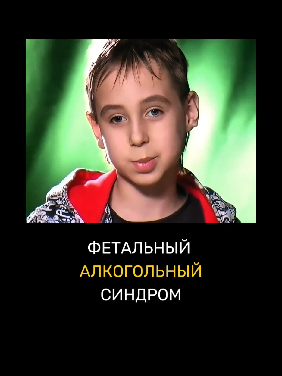 Знали о таком влиянии алкоголя? По этим признакам на лице в роддомах определяют ФАС - фетальный алкогольный синдром. Он бывает у детей от матерей, которые злоупотребляют алкоголем. Даже если это происходит нечасто, последствия могут быть фатальными. Стоит ли рисковать здоровьем своего малыша?