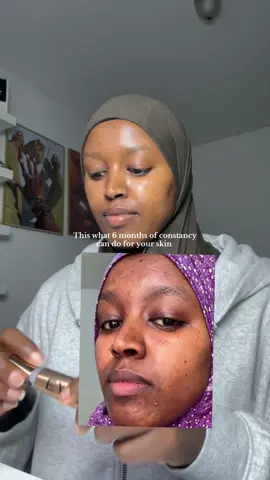 If you start now you might have your dream skin soon  #skintransformation #glassskinroutine #hyerpigmentation  #beforeafter #dreamskin @EADEM 