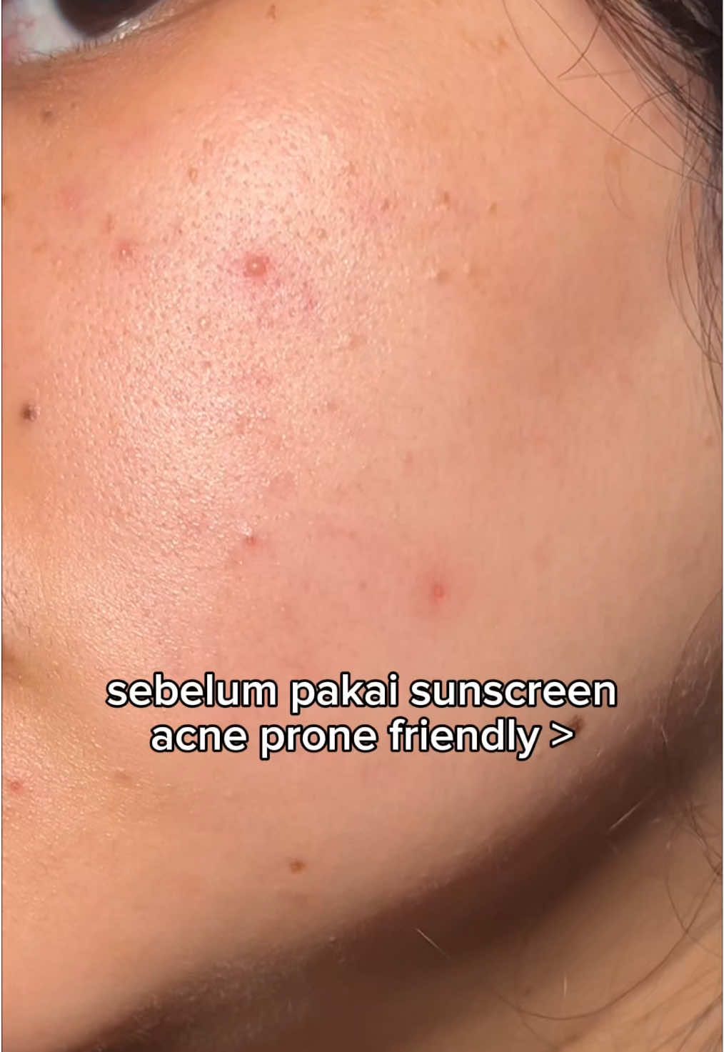 Kalo lagi jerawatan mending pake sunscreen khusus acneprone skin #sunscreen #acneproneskin #sunscreenviral #rekomendasisunscreen #oilyskin 