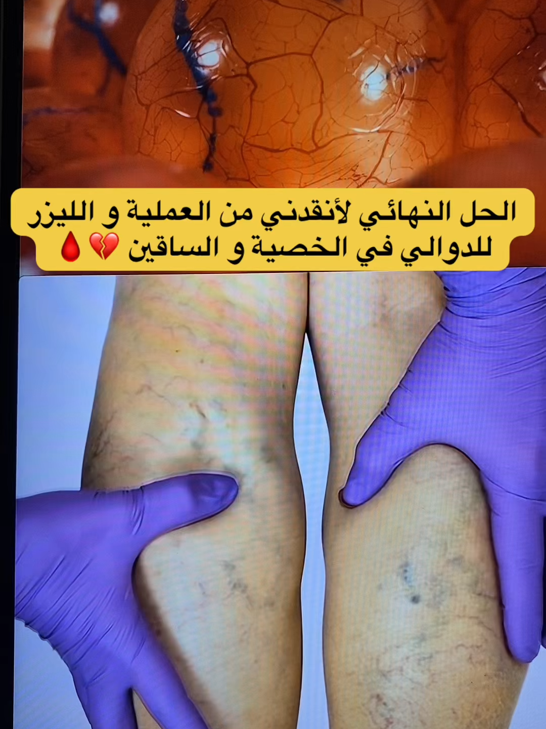 #الدوالي_الدوالي #دوالي_الخصيه #الدوالي #الدوالي_العنكبوتيه #الرياض_الان #استشارات_طبية #دكتوره_رحمه_الغيلي #معلومات_طبية #رحمة_الغيلي #تيك_توك_عرب #مكة_المكرمة #الطائف_الان #الدمام_الخبر_الشرقيه #الدوالي_الوريديه_أسبابها_وأعراضها #saudiarabia🇸🇦 #اكسبلور #93saudinationalday