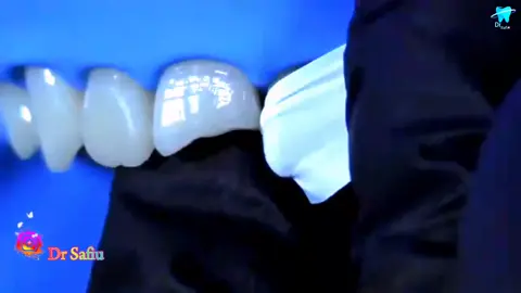 FRACTURE CENTRAL INSISOR TOOTH COMPOSITE RESTORATION#drsafiu  #unfrezzmyaccount #foryoupageofficiall #dontremovesound #tiktok 