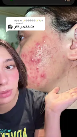 Replying to @✨Ⓔⓢⓡⓐⓐ✨🍡 #acnetreatment #glassskin #skincare #tretinoin #اكرتين 