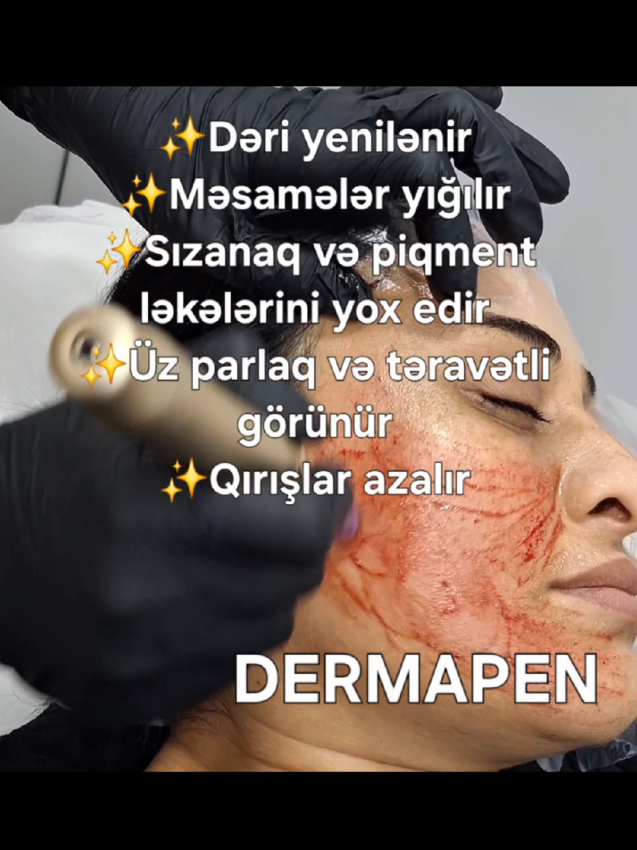 🌸 Dermapen#dermapen  #dermapen #prp #keşfet #keşfetteyiz 