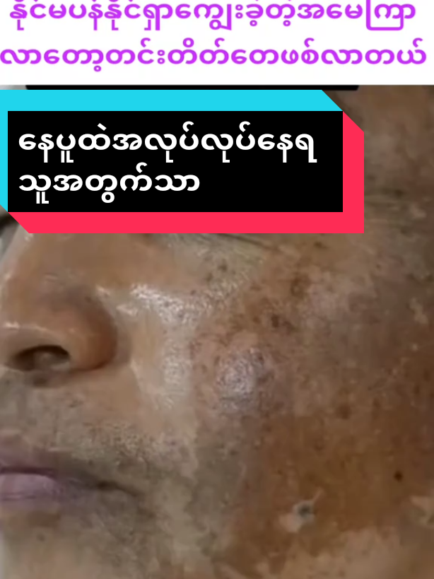 uzumakigod18#နေပူထဲအလုပ်လုပ်တဲ့သူတွေအတွက် #တင်းတိပ်အမဲစက်အမာရွတ်ပျောက်ချင်မှသုံး #တလစာ၃ထုပ်ဘဲသုံး #viber09458460617 #မပျောက်ရင်ငွေပြန်အမ်းမယ် @မလဲ့💙 