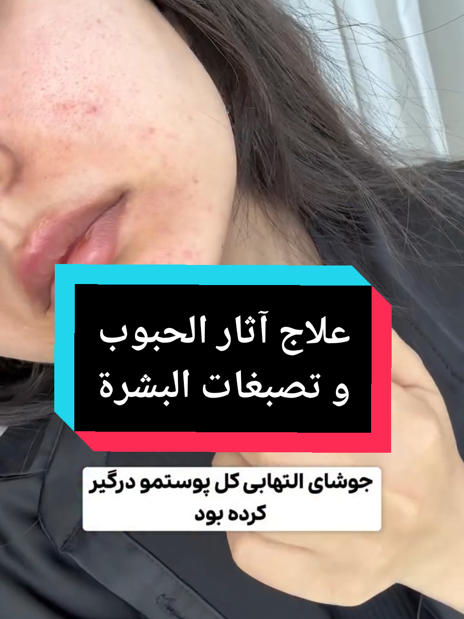 المكونات:قهوة+نشا+حليب بودرة+زبادي طريقة الاستخدام:20 دقيقة ⏰ مرتين بالاسبوع ✅  #foryou #اكسبلور #fyp #حبوب_الوجه #آثارـالحبوب ثارـالحبوب 