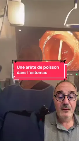 Une arête de poisson dans l’estomac #fibroscopie #gastro #medicaltiktok #medecine #poisson  