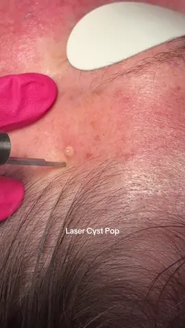 Laser Cyst Removal✨ Cysts are closed sacs under the skin filled with white cheesy material called Keratin. It’s like a pocket that forms when skin cells  and oil get trapped instead of shedding off the normally. Who needs a scalpel when there’s a laser beam⚡️Here I’m using a CO2 laser to extract a small cyst on the face Have you ever had a cyst? They’re super common! #oddlysatisfyingvideo #pimplepopping #dermatologist #laser #cameraroll 
