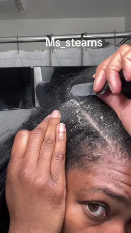 Yall really made me block my face this time 🤣🤣🤣🤣 i love yall but i can’t stand yall 🤣🤣🤣🤣 #sebboricdermatitis #sebborheicdermatitis #dandruff #flakes #scratching 