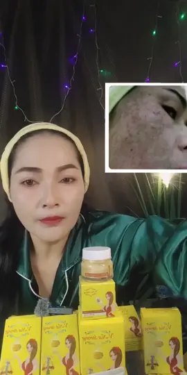 สบู่วีนัสฯ ดูแลฝ้า, กระ, สิว, ผิวหมองคล้ำ! ส่วนผสมจากธรรมชาติเพื่อผิวสวยใส