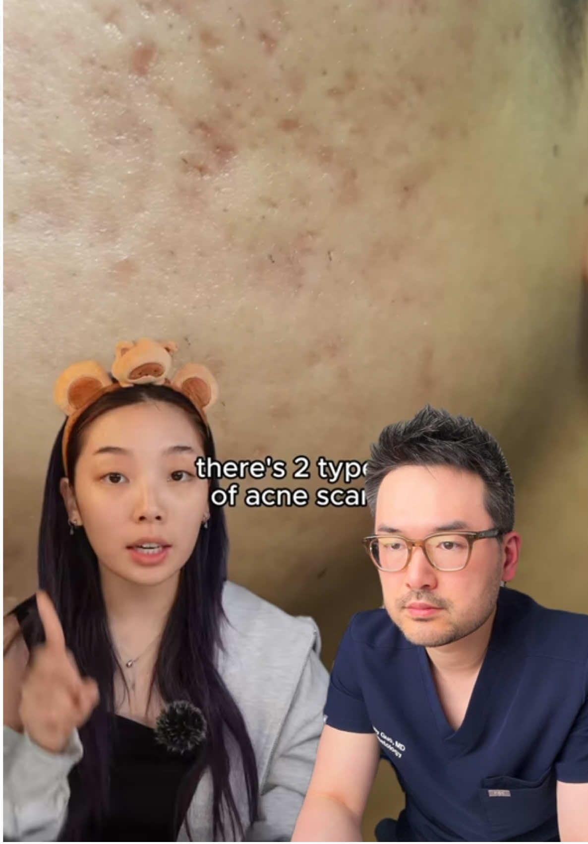 PIE and PIH are not scars. Icepick, boxcar, and rolling scars are true atrophic acne scars 😑 #skincare #dermatologist 