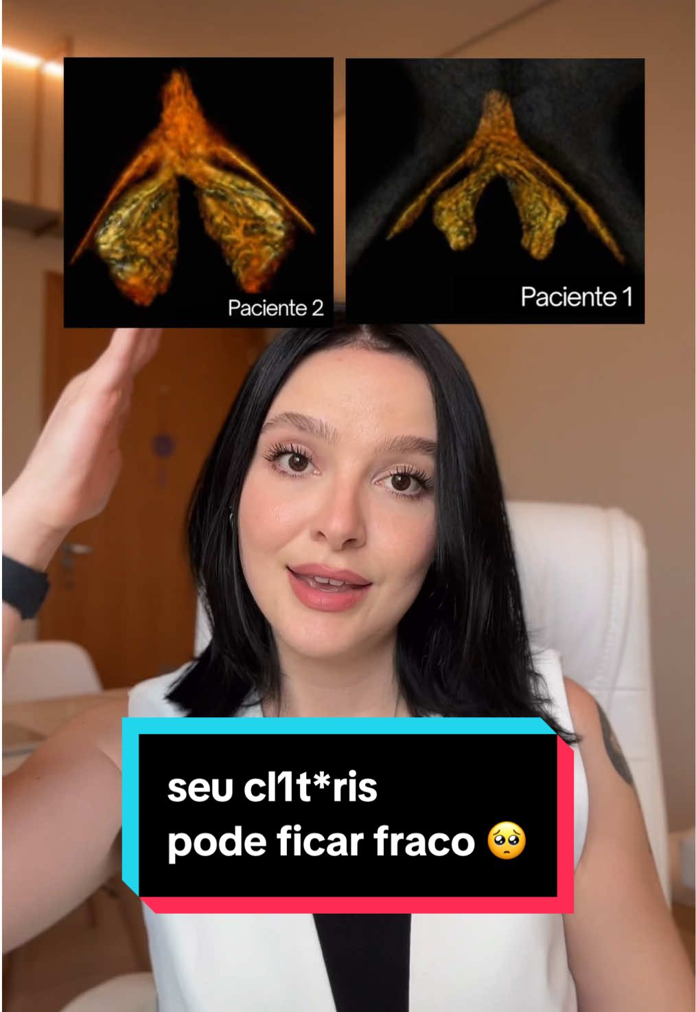 Quando falamos em falta de uso, estamos nos referindo à ausência de estímulo s3xu4l, toque, excitação ou org*smos por longos períodos. O clit*ris é um órgão altamente vascularizado e enervado, e depende do fluxo sanguíneo e da oxigenação regular para manter o tecido saudável. Sem estímulo, ocorre: - Redução do fluxo sanguíneo local (menos oxigênio e nutrientes) - Menor expansão dos corpos eréteis (menos oxigenação dos tecidos) - Diminuição da sensibilidade por falta de estímulo Assim como qualquer outra estrutura corporal, o que não é usado tende a regredir. No caso do clit*ris, o desuso prolongado pode levar a uma hipotrofia funcional, o tecido fica menos responsivo, a exc1t4çãO demora mais e o prazer pode reduzir. É uma redução na vitalidade, circulação e sensibilidade do órgão. A reativação pode ser feita por meio de: 1. Autoexploração e toque consciente — o simples estímulo físico e mental já aumenta o fluxo sanguíneo local. 2. Excitação regular (com ou sem parceiro) - manter a resposta sexual ativa preserva a função clitoriana e neural. 3. Cuidado com a dor na relação — ela pode fazer você evitar o estímulo e perpetuar o desuso (essa dor tem solução com fisioterapia pélvica).