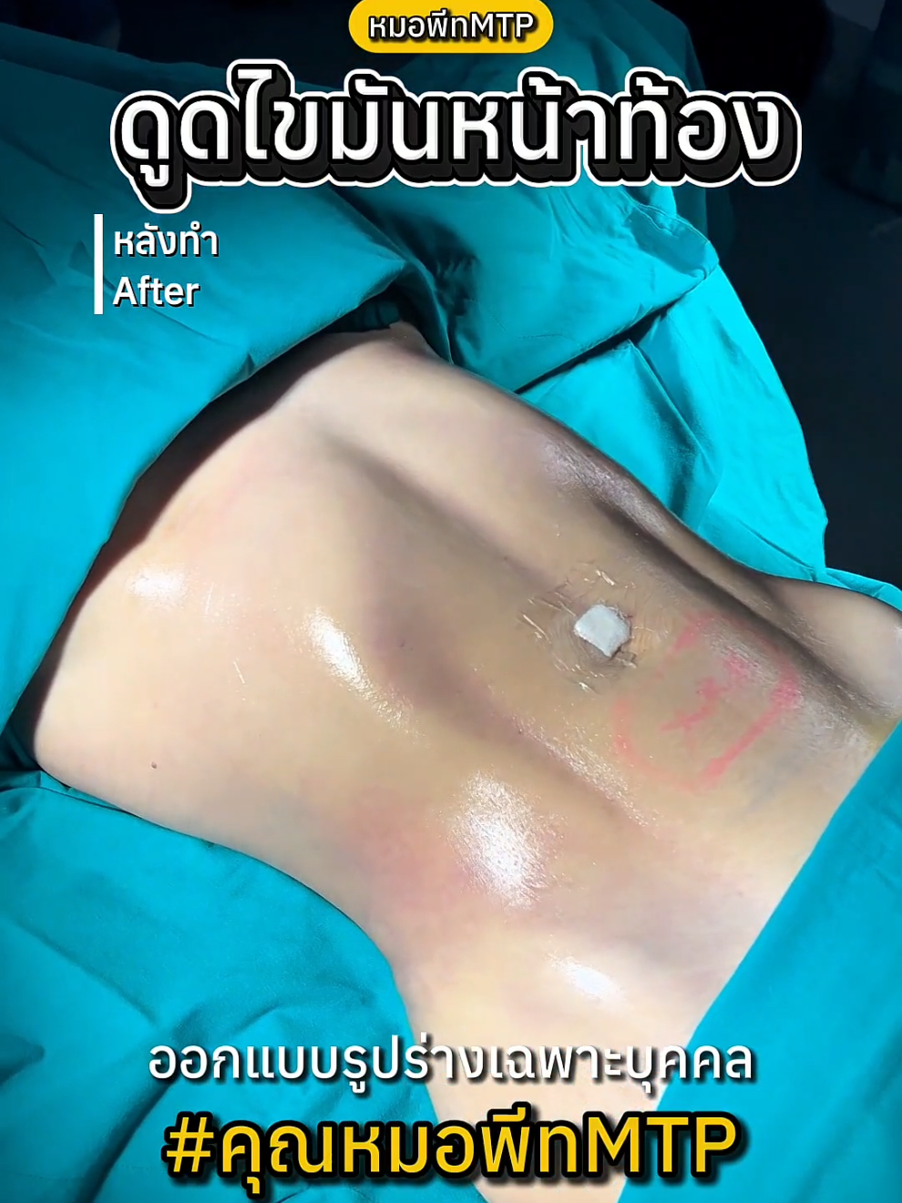 นี่แหละ Sexy line ที่ตามหา‼️😱 ดูดไขมันหน้าท้อง กับ #คุณหมอพีทMTP หลังทำทันที หน้าท้องแบนราบ เอวเอส sexy line ชัด💕✨ #ดูดไขมันหน้าท้อง #ดูดไขมันมาสเตอร์พีช #ดูดไขมัน #โรงพยาบาลมาสเตอร์พีช 