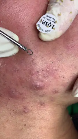 Rỉa#chamsocdamun#chamsocdaseo#chamsocdanam#tanbinh#Lqspa&academy