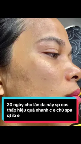 Ib e tặng phác đồ nám nhanh hiệu quả cos cực thấp#điều_trị_mụn_nám_rỗ_tàn_nhang #dieutrinam #xuhuong #xâykenh 