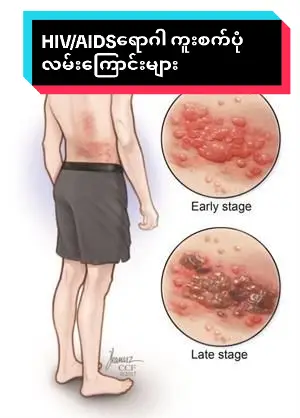 #crd #HIV #AIDS #healthtips #ကူးစက်ပုံ #ကျန်းမာရေးဗဟုသုတ #follower🥺❤️ 