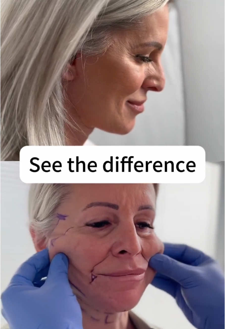 „Kennst du das, wenn du immer müde aussiehst – obwohl du dich gar nicht so fühlst?💭 Oft ist das einfach Haut, die ein bisschen hängt。 Mit einem kleinen Schnitt lässt sich das ganz natürlich liften✨ Würdest du’s ausprobieren?“ #facelift #miniFacelift #natürlicheschönheit #antiaging #hautpflege #beautytrend #gesichtslifting #skincaredeutschland #ästhetik