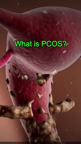 What is PCOS?#DidYouKnow #nowyouknow #healthtips #usa_tiktok 