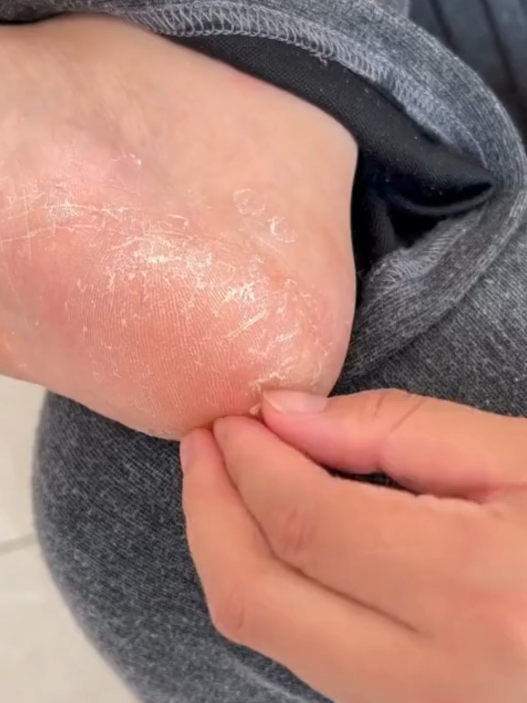 ADIOS a los talones agrietados | Mi secreto de urea #tiktokshopblackfriday #ureacream #tiktokshop #tiktokshopcybermonday #MiracleProduct #Skincare #BodyCare #GoodStuff #footcaretok #feetcarearoutine #yecuceureacream #beforeandafter #afforable #moisturizer #tiktokmademebuyit #urea #CrackedSkin #feetcare #heel