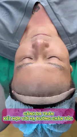 ANH TRAI CAN ĐẢM HẠ CHÂN TÓC VÀ CĂNG DA TRÁN#phauthuatthammy 
