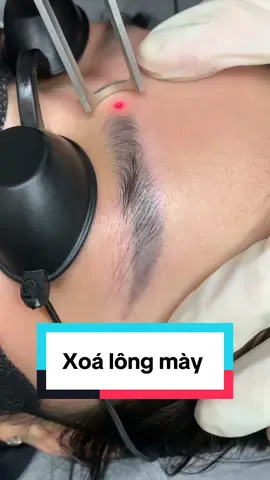Xoá xăm lông mày hiện đại #xoaxam #xoaxamlaser #xoalongmay 