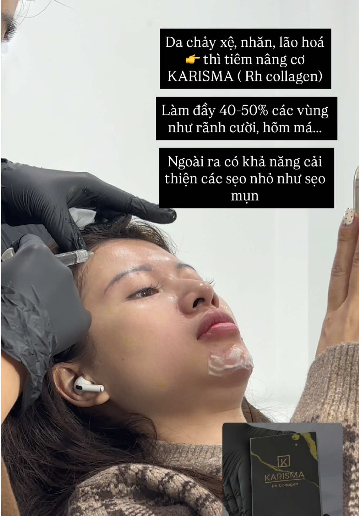 Karisma không phải là tiêm filler, cũng không phải tiêm botox.  Mà là TIÊM TRẺ HOÁ DA ( collagen nhân tạo- tái tạo da từ trong) ❌ Công dụng chính: - Nâng cơ, săn da - Da căng bóng, sáng hơn - Làm đầy và cải thiện nếp nhăn nhỏ 👉 Hiệu quả: - Kết quả thấy rõ sau 1-2 tuần  - Kéo dài 6-12 tháng tuỳ cơ địa và cách chăm sóc #lionbeautycenter #trehoada #karisma #karismarhcollagen 