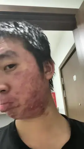 Nhớ lại 4 ngày trước khủng hoảng dữ, nay trộm vía dữ lun gòi cả nhà ơi #mụn #tâmtrạng #leannhien #trimun 