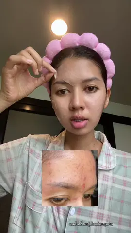 คือเริ่ดดดดดด #ส้มโอที่หน้าเป็นสิว #แผ่นแปะซิลิโคน #แผ่นแปะซิลิโคนเจล #ใช้ดีบอกต่อ #ป้ายยาtiktok 