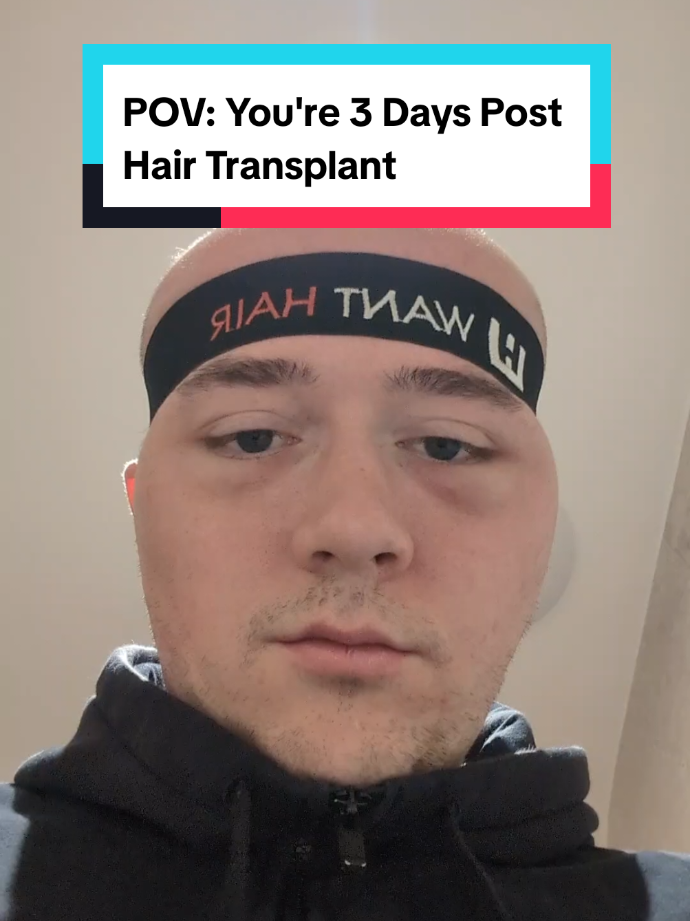 the dent at the end 😭😭 #hairtransplantswelling #hairtransplant 