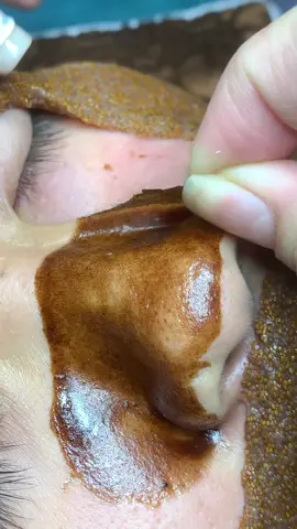 Ngon #chamsocdamun#chamsocdaseo#chamsocdanam#tanbinh#Lqspa&academy 