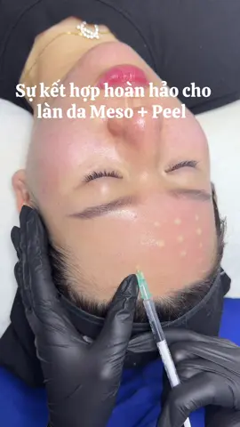 Thời điểm vàng để chăm da đón tết rồi nè mấy bà 🥰 #mesotherapy #peelda #cangbong #phuchoi #kwanbeautyrelax 