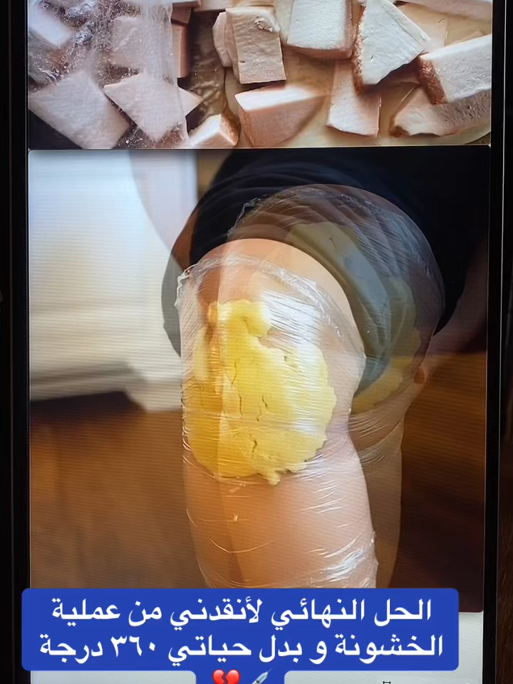 #خشونة_مفاصل_الركبة #خشونة_الفقرات #خشونة_المفاصل #التهابات_المفاصل_وغضاريف_الركبة #الدمام_الخبر_الشرقيه_الاحساء_الهفوف #الدمام_الخبر_الاحساء_الجبيل_الظهران #عرق_النسا #المدينة_المنورة #الرقبة #الرياض_الان_ #السعودية #اليوم_الوطني #جدة_الان #اليوم_الوطني_السعودي_94 #مكه #ألم #اليوم_الوطني_السعودي_٩٤