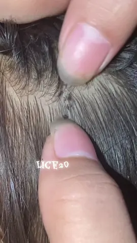 oh so many lice #omg #lice #liceremoval 