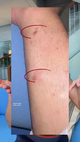 I have some dark marks and uneven tone left from my healed psoriasis. That’s why I’m trying this combo from Dermo Republic. I really hope it works for me.  🙏 Soon I’ll be posting updating videos soon. #psoriasis #glycolicacid #niacinamide 