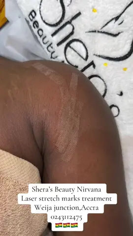 CO2 laser treatment as a solution for reducing Stretch marks, pregnancy stretch marks,wrinkles, scars,saggy skin,cutting keloids and more . It works by resurfacing the skin, stimulating collagen production, and improving elasticity. The treatment aims to provide smoother, tighter, and younger-looking skin in a few sessions, reducing fine lines, acne scars, stretch marks, pigmentation, and open pores. The number of sessions varies based on the severity of the stretch marks and individual skin response. Some patients see improvement after the first session,  A consultation with a laser specialist is essential to determine the ideal number of sessions for your specific condition. ☎️Bookings/enquires :0243112475 ⏰Working Hours : Mon - Sat [9am - 7pm] 📍location:Weija junction Find us on goggle map ,uber, bolt @Shera's beauty nirvana (SPA) #stretchmarkstreatment #weija #ghanafyp👍👍❤️❤️❤️🇬🇭🇬🇭🇬🇧 #usaghana🇬🇭🇱🇷 #skincaretreatment 