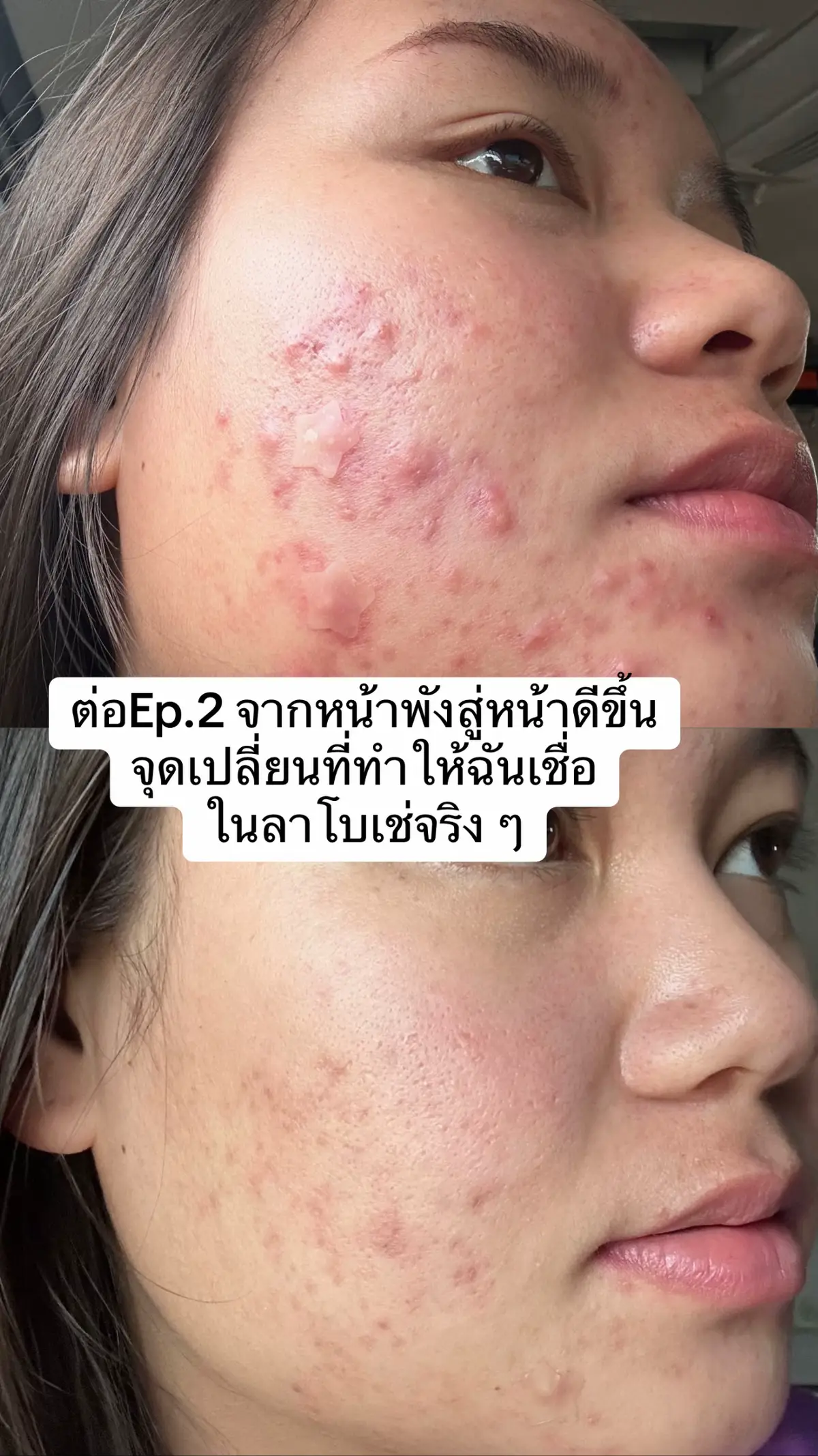 มาค้าา แชร์ๆ #รีวิวลาโบเช่ #เจ้าของแบรนด์ลาโบเช่ #ลาโบเช่ #ประสบการณ์เป็นสิว #ลาโบเช่ 