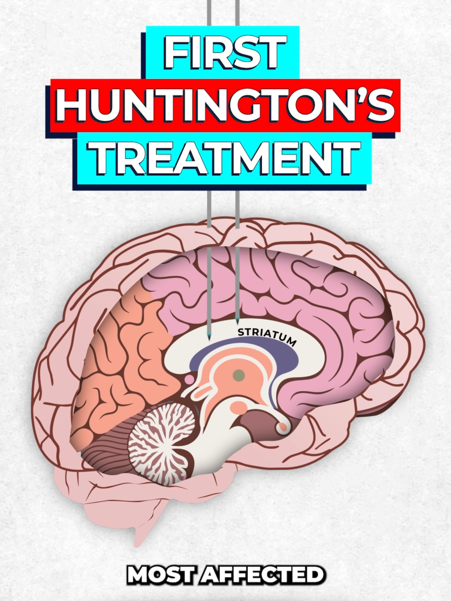 Somewhere Dr House just threw his cane at an FDA rep 🧬 Full video here: https://youtu.be/g66x9funPc0 #Huntingtons #Breakthrough #Medicine #sciencetok #fyp