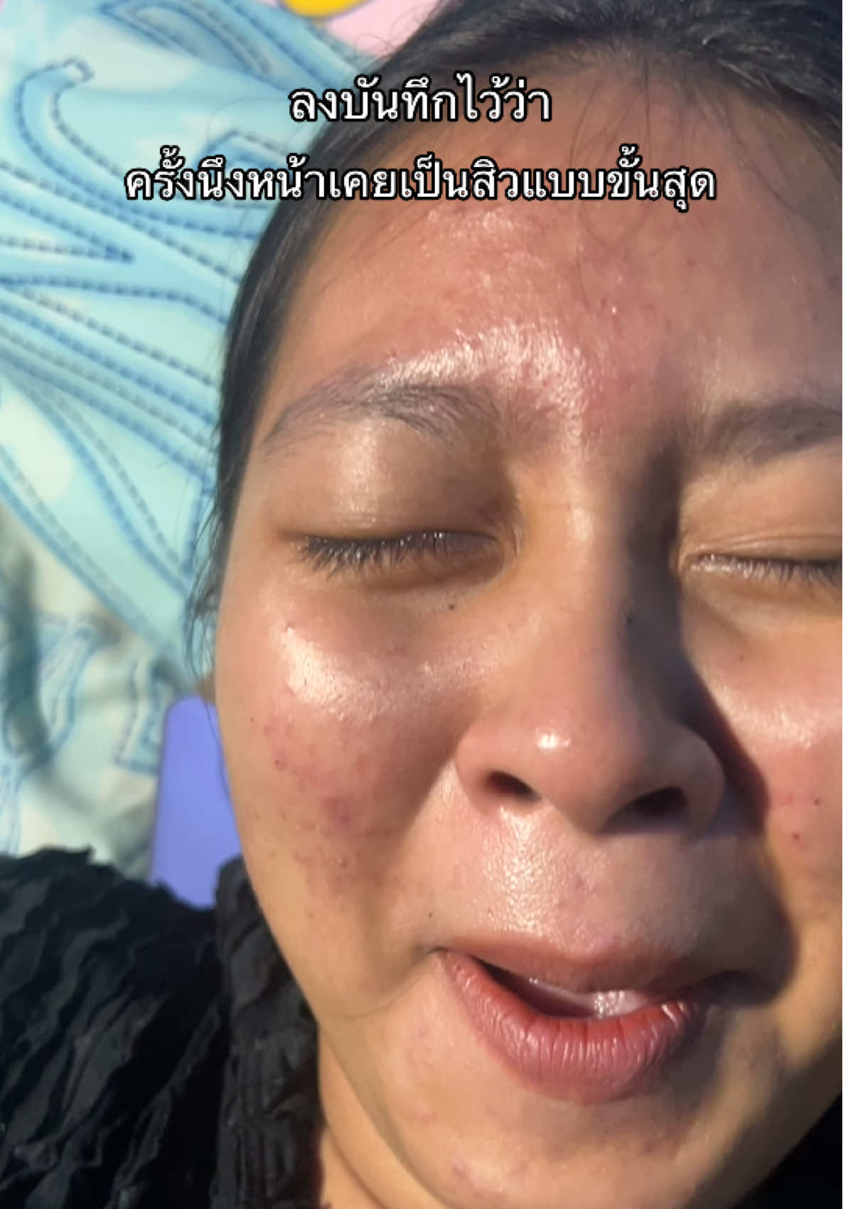 สิวเรื้อรังเป็นปีแต่มาหายได้ด้วยครีมโสมโซเม่ น้องเปิดตัวเร็วๆนี้นะคะ #ครีมโสมโซเม่ #ครีมหน้าใส #แบรนด์ridarich 