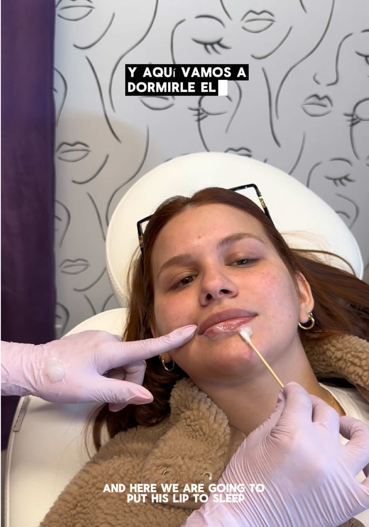 @Gigi_nurseinjector 📍El Paso, TX fue la encargada de disolverme ácido hialuronico que tenía de hace 4 años ✨🪄 #lipfiller #lipfillers #lipfillerremoval 