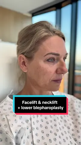 My beautiful 54 y.o. client, 2 weeks after deep plane facelift, deep necklift and lower blepharoplasty😍 All done under local anesthesia💪 📲If you want to make an appointment, contact me at contact@v-clinic.cz #facelift #necklift #blepharoplasty #plasticsurgery