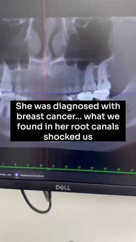 She was just diagnosed with breast cancer… and her functional medicine doctor told her to get her root canals checked. 🦷 What we found on her cone beam scan shocked us — massive hidden infections that were leaking bacteria into her bloodstream every time she ate. Your mouth and your body are deeply connected. If you’re facing chronic illness, fatigue, or inflammation, don’t overlook your dental health. This is why I never recommend root canals, they can harbor bacteria and lead to infection. You have options. Comment 