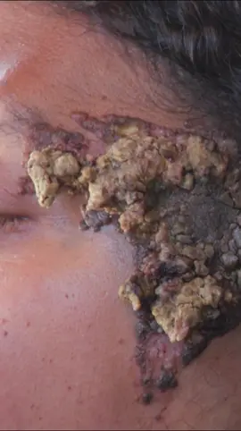 Jordan's birthmark is taking over her face...and her life! See the surgeons tackle her case on #AboutFace, Wednesday at 10/9c.