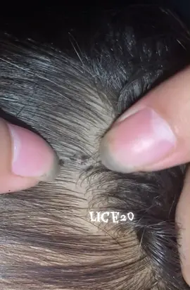 😱😱😱#omg #lice #liceremoval 