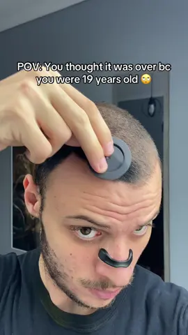 It’s not over. Balding can be fixed 