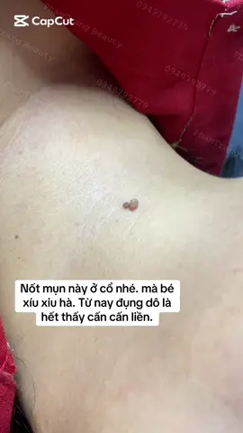 #mụnthịt #mụncoc #bmt47 #phamtrang_home_spa #viral