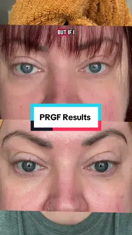 Come with me to get PRGF Platelet rich growth factor in my under eyes. Week 8 results. Before and after. #prgf #botox #aesthetics #undereye 